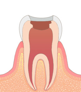 虫歯 治療 後 激痛