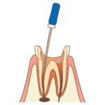 歯の根の治療はどんな道具を使っているの？