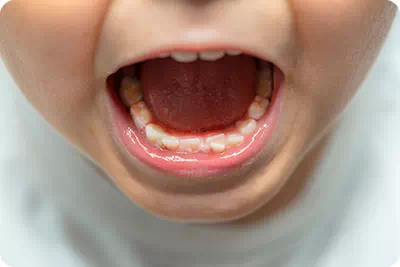 口を開けた子供の写真