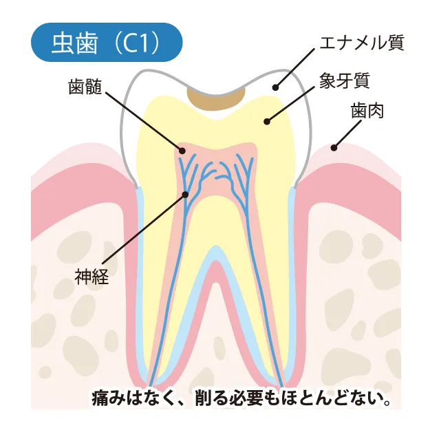 初期むし歯の画像