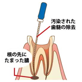 根管の消毒・清掃を行っている画像