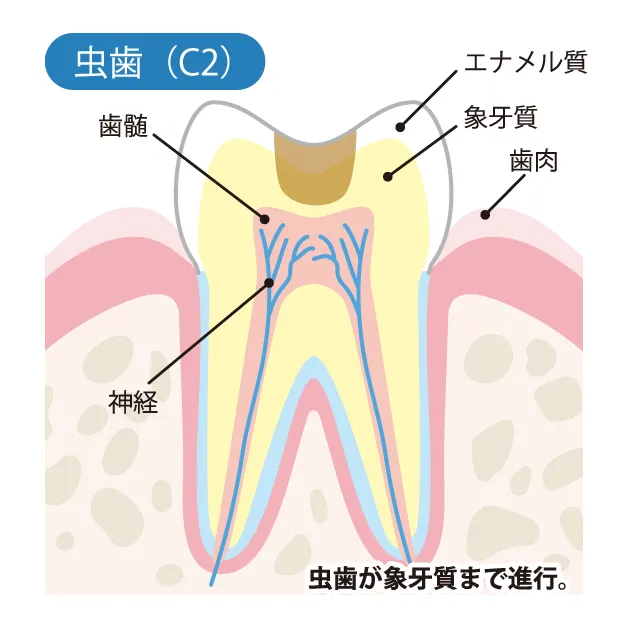 エナメル質が解けた状態の画像