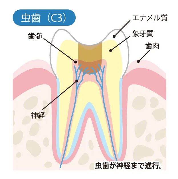  象牙質まで虫歯が進行した状態の画像