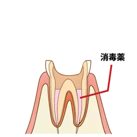 充填剤で根管内を密閉している画像