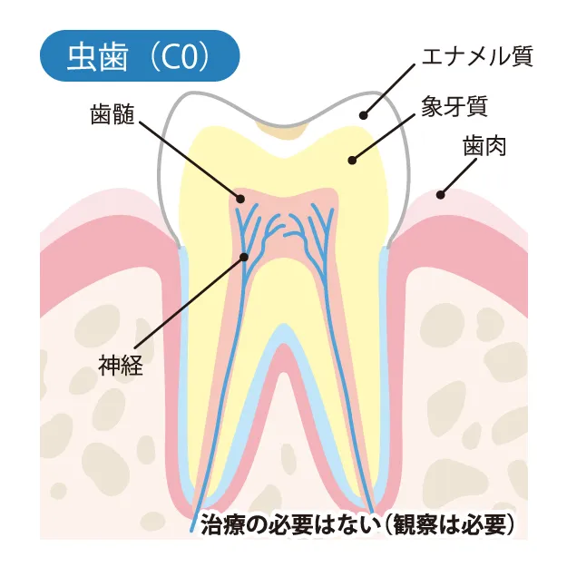 むし歯の始まりの画像