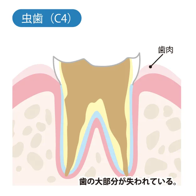虫歯が進行し、神経（歯髄）が死んでしまっている状態の画像