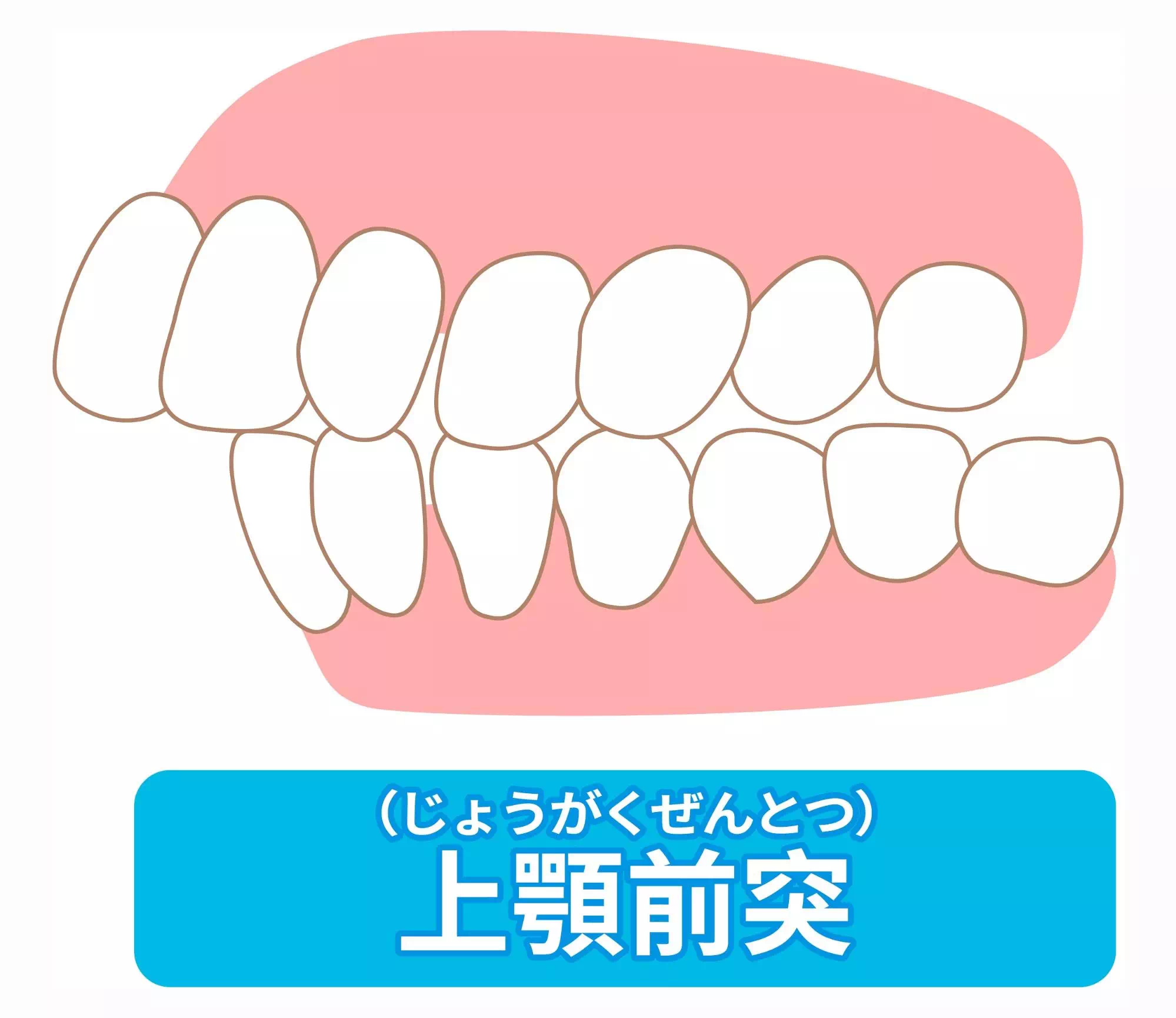 上顎前突の画像