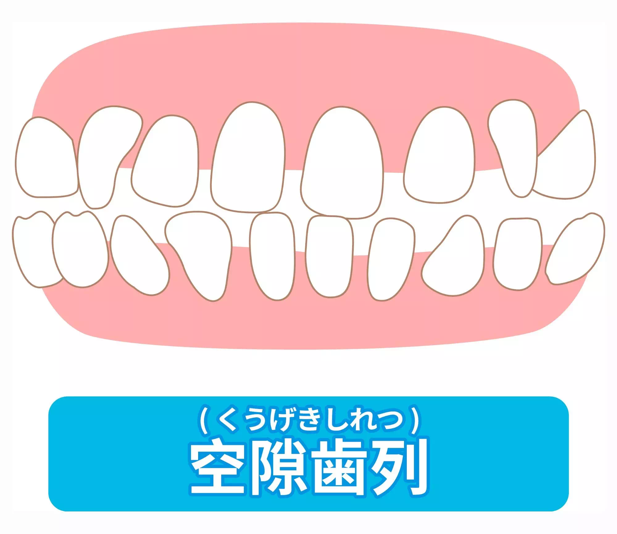 空隙歯列の画像