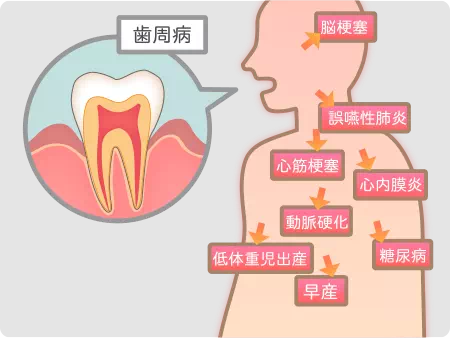 歯周病と全身疾患の関係の画像