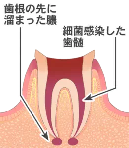 実際の治療の画像(STEP01)