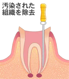 実際の治療の画像(STEP02)