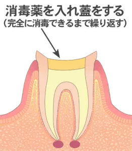 実際の治療の画像(STEP03)