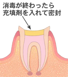 実際の治療の画像(STEP04)
