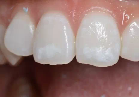 歯のシミュレーション画像