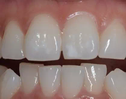 歯のシミュレーション画像