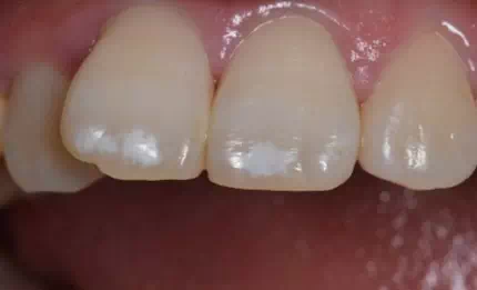 歯のシミュレーション画像