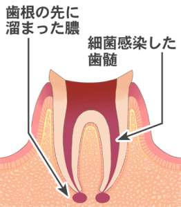 根の治療