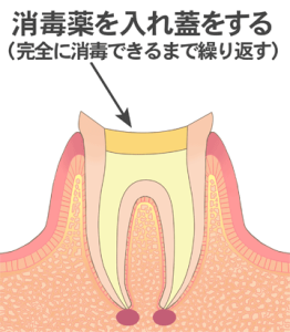 根の治療