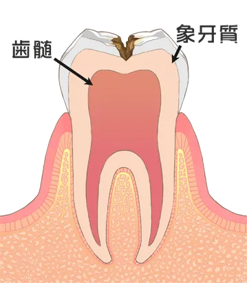 中等度虫歯