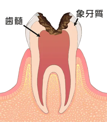 重度虫歯