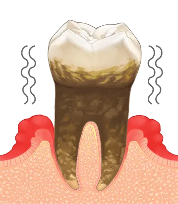 重度歯周病