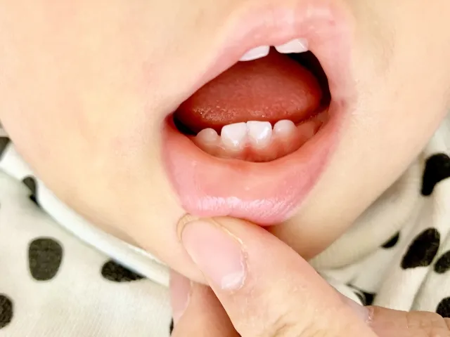 受け口自然改善